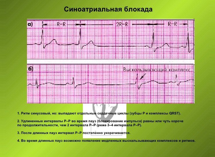 Сбился ритм. ЭКГ расшифровка синусовый ритм. Э́КГ av блокада 2 степени синусовый ритм. Кардиограмма сердца расшифровка синусовый ритм. Блокада это в ЭКГ синусовый ритм это.