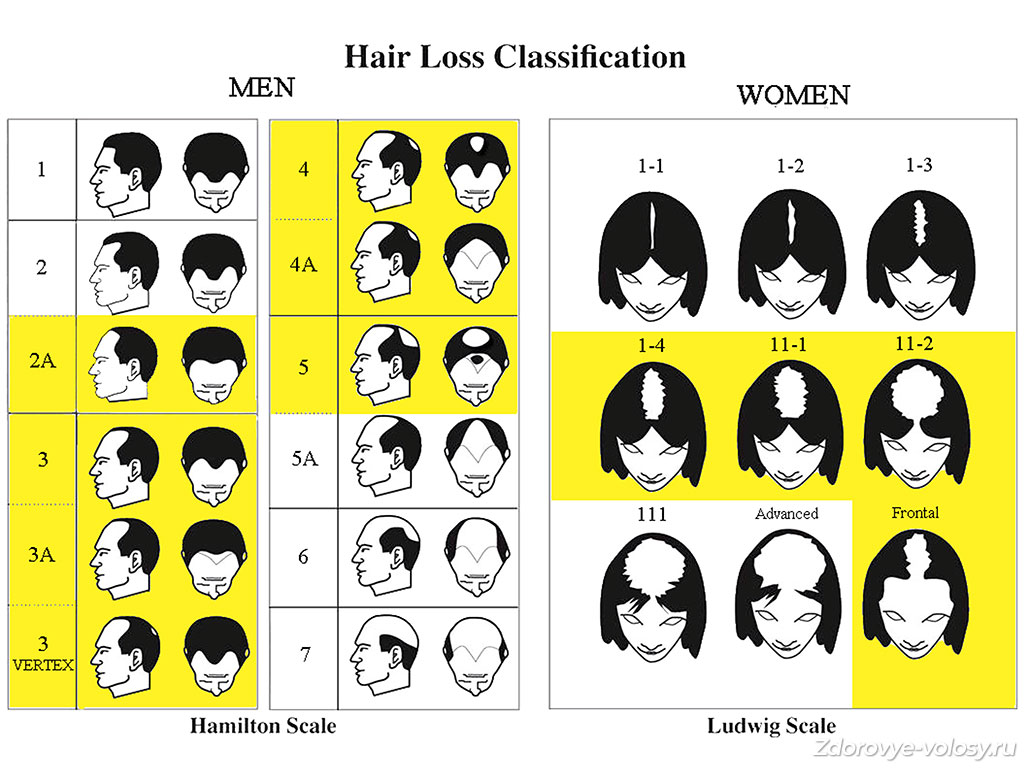 Выпадение волос классификация по
