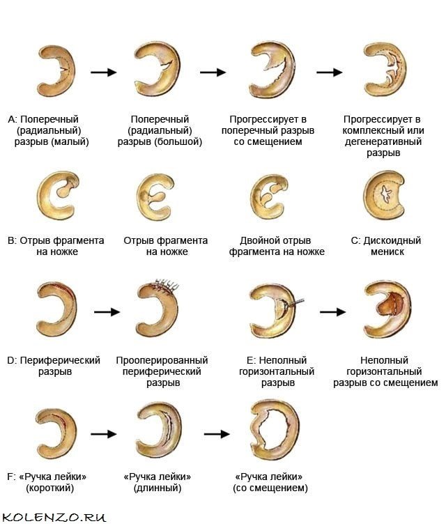 Разрыв мениска коленного сустава симптомы и лечение. Травма мениска по типу ручки лейки. Классификация разрыва мениска по Stoller. Повреждение внутреннего мениска 3 б степени по Stoller. Типы повреждения менисков по Столлер.
